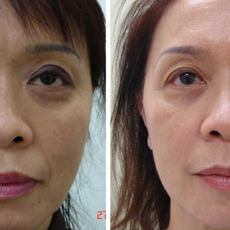 Special offers- Clearlift treatment before and after
