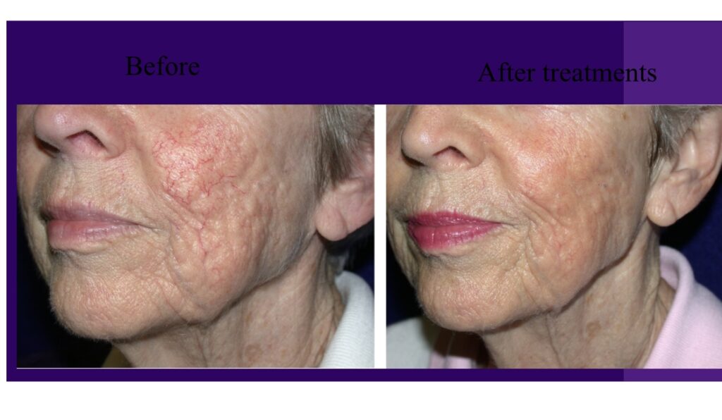 Facelift Lunchtime facial Clearlift laser treatment Laserpod