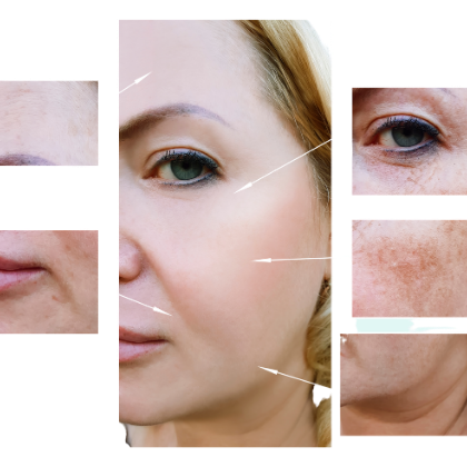 Pigmentation on a woman's face