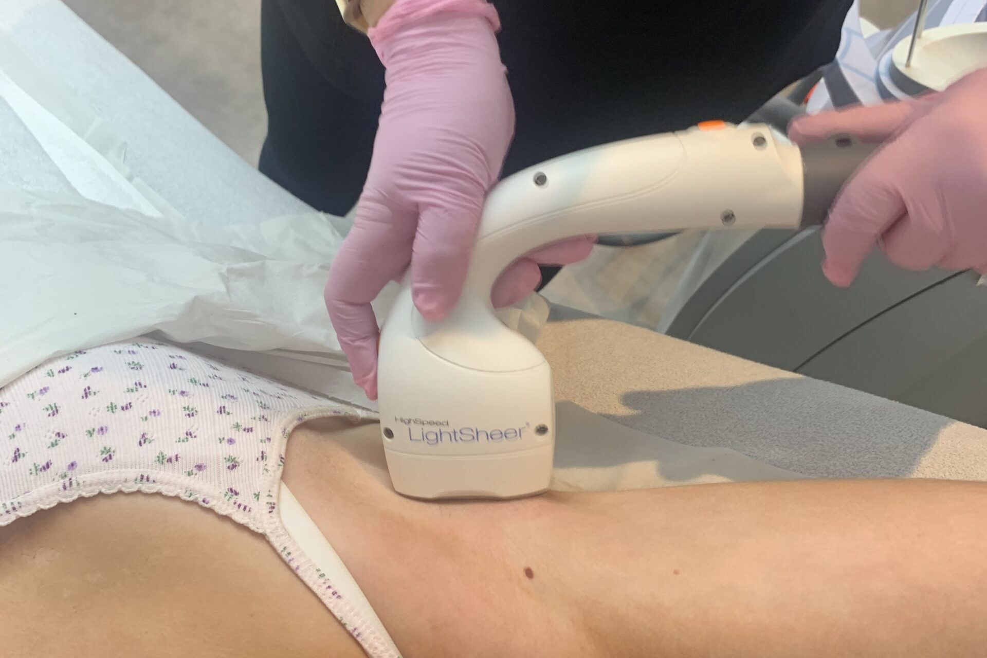 Laser hair removal underarm