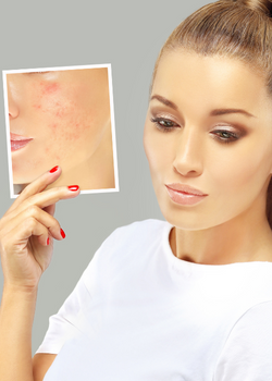 acne scare treatment